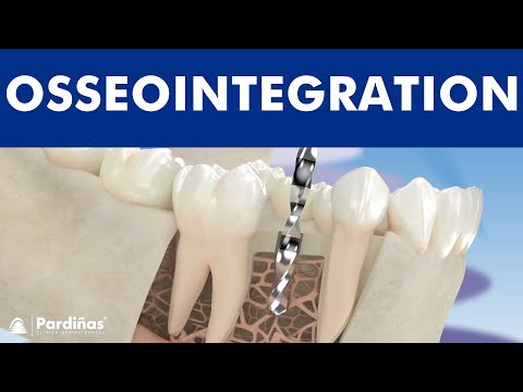 Osseointegration Of Dental Implants © - YouTube