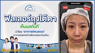 รีวิวจากคนไข้จริง - คุณก้อย ฉีดฟิลเลอร์แก้ปัญหาถุงใต้ตา นำโดยอาจารย์หมอเมฆ ที่ DoctorMek Clinic