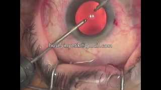 KATARAKT AMELİYATI Cataract Phacoemulsification Surgery in TURKEY  Dr. Huseyin Yetik