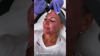 Lumenis triLift Treatment Video