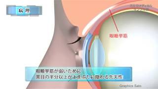 眼瞼下垂／2分で分かる医療動画辞典　ミルメディカル