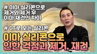 이마 실리콘으로 인한 걱정과 제거 수술, 재건 수술에 관하여