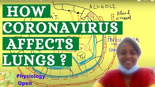 Coronavirus pathophysiology | Pneumonia caused by coronavirus