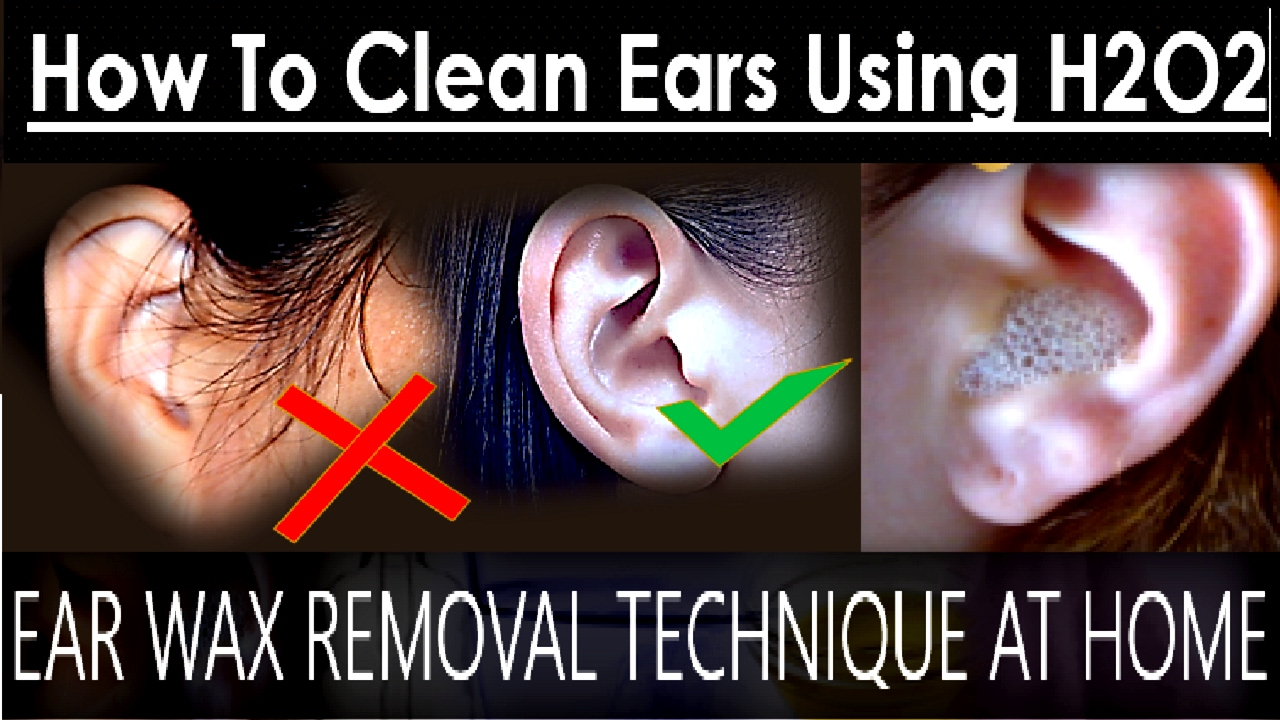 Ear Wax Removal Technique At Home | How To Clean Ears Using Hydrogen ...