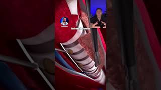 An amazing operation to remove the thyroid with no visible scar!