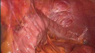 Laparoscopy 22 months after extended D2-gastrectomy