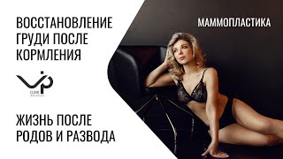 Подтяжка груди.  Мастопексия.  История пациента VIP Clinic Радмилы