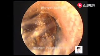 Last video in 2019｜Dr Zhao Earwax removal