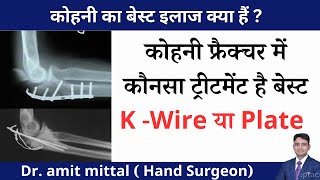 कोहनी फ्रैक्चर में कौनसा ट्रीटमेंट है बेस्ट K-Wire या Plate जानिए डॉक्टर के द्वारा | Elbow Fracture