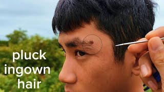 PLUCK INGROWN HAIR and spit white hairs for mr Lượng chăn bò asmr