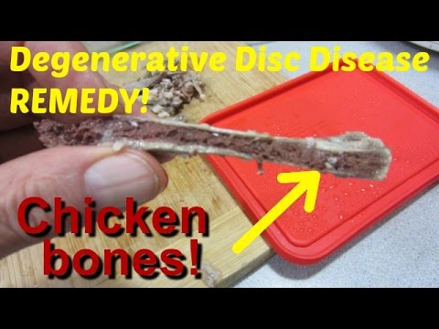STOP Degenerative Disc Disease! (DDD) Treatment to AVOID Surgery! STOP Degenerative Disc Disease! (DDD) Treatment to AVOID Surgery!