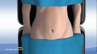 Robotic Single Incision Gallbladder Removal