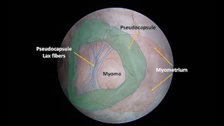 Cold Scissors Hysteroscopic Myomectomy