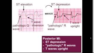 Posterior MI:  \