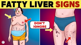 Fatty Liver Symptoms (2024 Update) | Fatty Liver Disease | Non Alcoholic Fatty Liver Disease