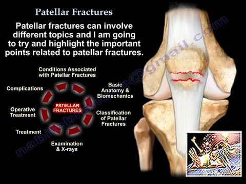 Patellar Fractures - Everything You Need To Know - Dr. Nabil Ebraheim ...