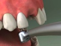 Dentist - Maryland Bridge Procedure