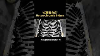 冷知識: 為甚麼有些人眼球可能不同的顏色？有可能是患有虹膜異色症heterochromia iridum，科普，腦洞大開，漲知識！