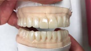 Full Mouth Wax-Up: Example Case | Dental Lab Learning