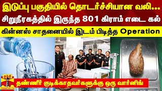 இடுப்பு பகுதியில் தொடர்ச்சியான வலி... சிறுநீரகத்தில் இருந்த 801 கிராம் எடை கல்...