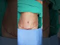 Tummy Tuck Surgery before & After Result #shorts #ytshort