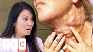 Woman Has Over A Thousand Lumps All Over Her Body | Dr. Pimple Popper: Before The Pop
