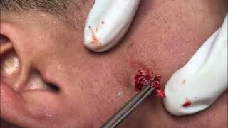 Compilation 10: GIANT ACNE and SEBACEOUS CYST removal! #pimple #squeeze #acneextraction #skincare