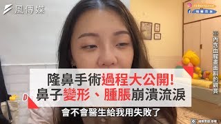 隆鼻手術過程大公開! 鼻子變形、腫脹崩潰流淚