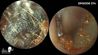 274 - Impacted \u0026 Matted Ear Wax Removal off the Eardrum using the #WAXscope®️