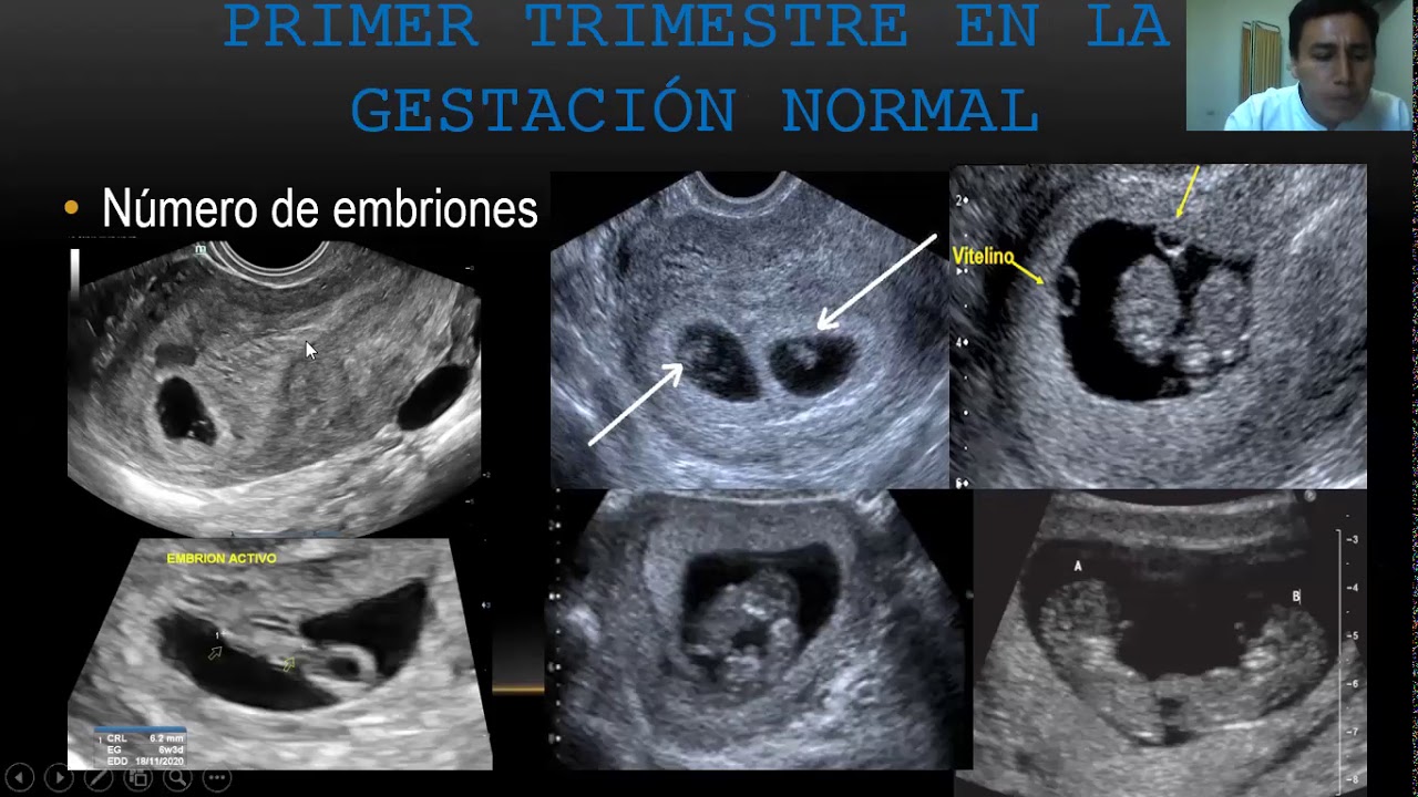 ABORDAJE ECOGRÁFICO EN EL PRIMER TRIMESTRE DE EMBARAZO EN LA GESTACIÓN ...