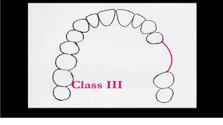 Basic principles of RPD design Cl III by Dr Emad Hanbali