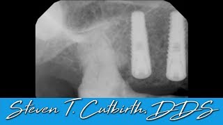 Everything you Need to Know about Implants, Bisphosphonates and Vitamin D - Steven T. Cutbirth, DDS