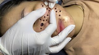 Blackheads \u0026 Acne Treatment 17.04.2024 (Part 4)