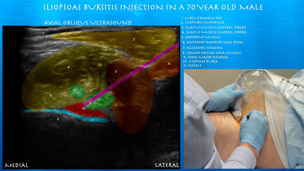 Ultrasound Guided Iliopsoas Bursts Injection By Probeultrasound - YouTube