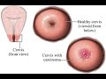 Cervical Cancer Cervical Cancer
