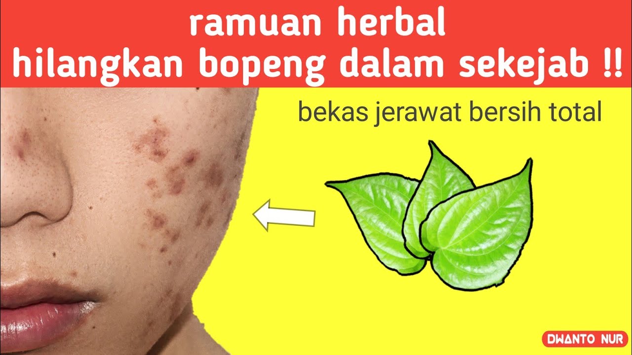 Cara Menghilangkan Bopeng Bekas Jerawat Dengan Cepat Dan Alami - YouTube