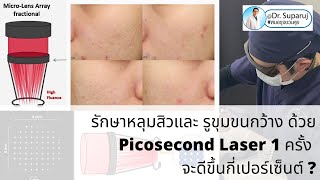 รักษาหลุมสิวและรูขุมขนกว้าง ด้วยโปรแกรม Discovery Pico Laser 1 ครั้งจะดีขึ้นกี่เปอร์เซ็นต์ ?