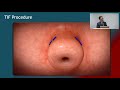 endoscopic treatment of gastro esophageal reflux disease gerd with dr. ken chang 17min