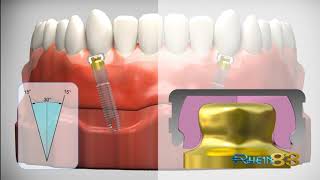 Ot Equator: Implant Retained Overdenture Attachment