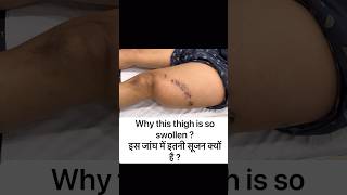 Is swelling in one leg serious? #shortsindia #swelling