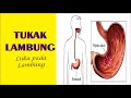 TUKAK LAMBUNG, Definisi, Gejala, Penyebab, Pengobatan dan Pencegahan