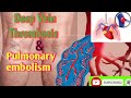 DVT ! Deep Vein Thrombosis & Pulmonary embolism ll Explained animation @medcareinfo7127