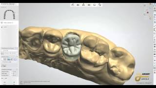 First case with 2014 3Shape Dental System