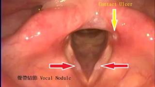 聲帶結節(聲帶長繭) 鼻咽腫塊 喉部接觸性潰瘍 vocal nodules, nasopharyngeal mass, contact ulcer