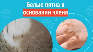 😶‍🌫️ Белые пятна в основании члена. Клинический случай №1258