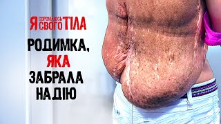 Невус, який розділив життя на ДО та ПІСЛЯ – Я соромлюсь свого тіла | МЕДИЦИНА | ЛІКАРІ | ЗДОРОВ’Я