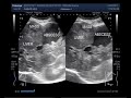 Ultrasound Video showing Hepatic Abscess with a mass.