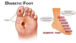 Diabetes and Poor Circulation-Imtiyaz I Kapadwala DPM Podiatry Vascular Specialist in Brooklyn NY