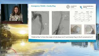 Emergency Treatment As Aortic Rupture From Chronic TBAD Using The Candy Plug Technique