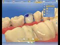 cerec sw 4.5.x positioning tool